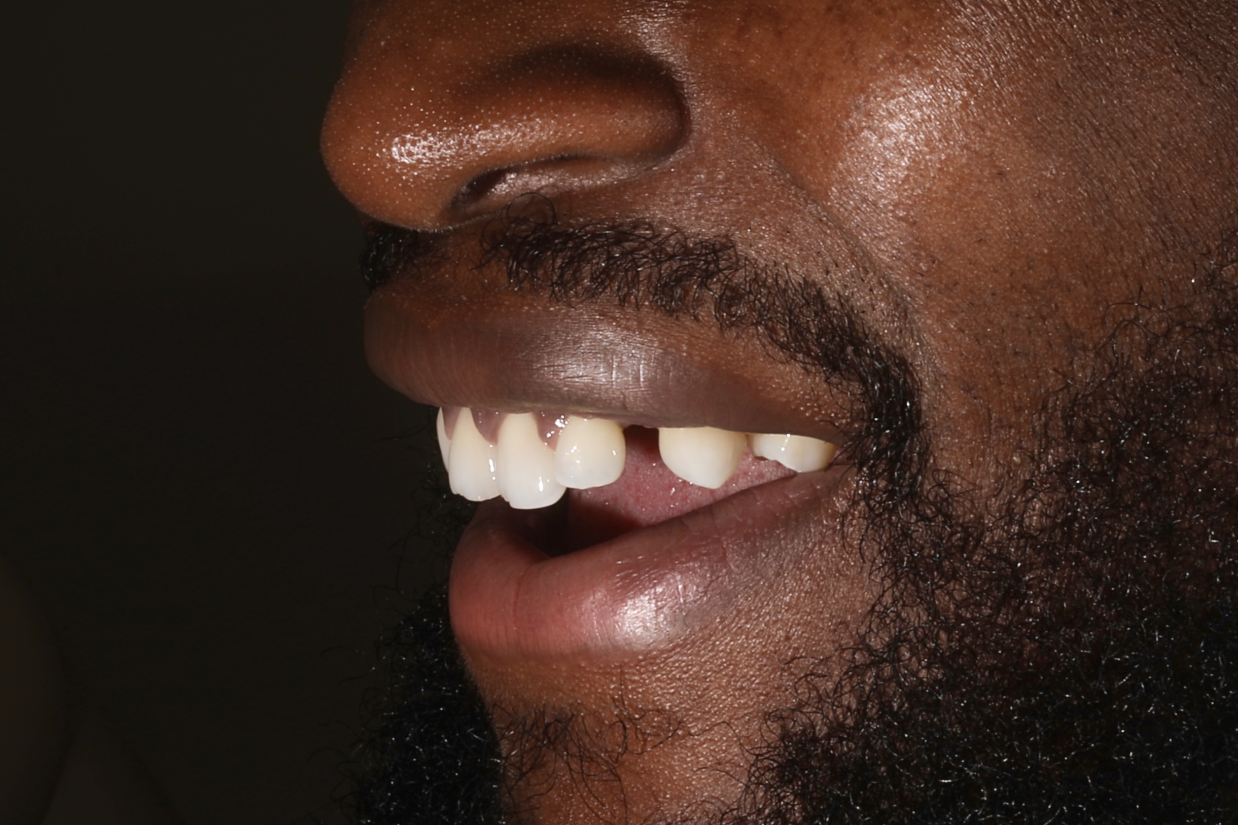 8 Porcelain Veneers to close gaps and reshape the teeth