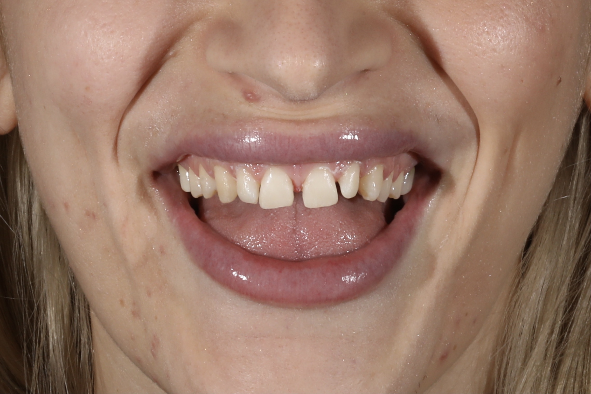10 Direct Composite Veneers to completely transform the smile