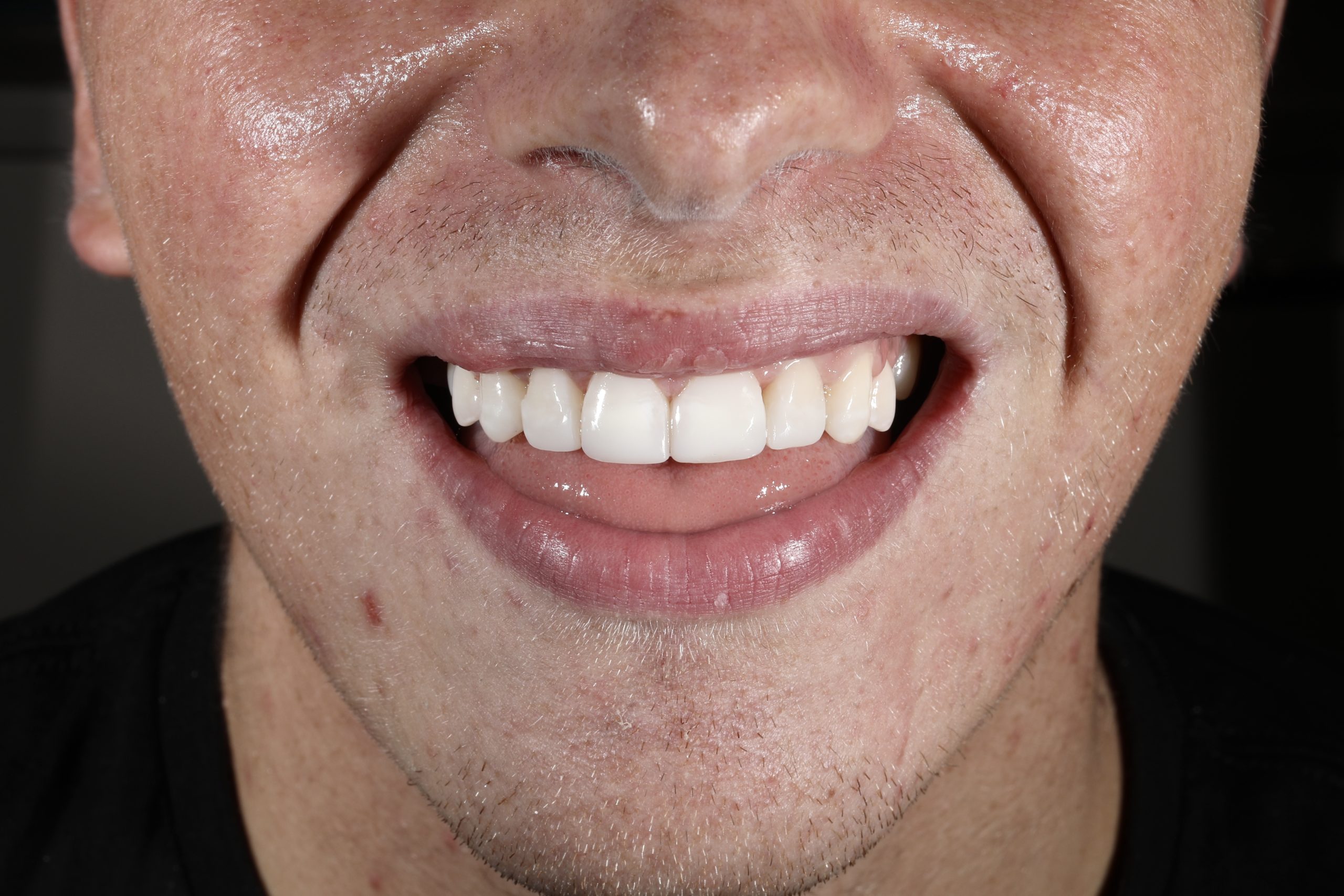 Covering patchy teeth with Direct Composite Veneers - Maison Dental