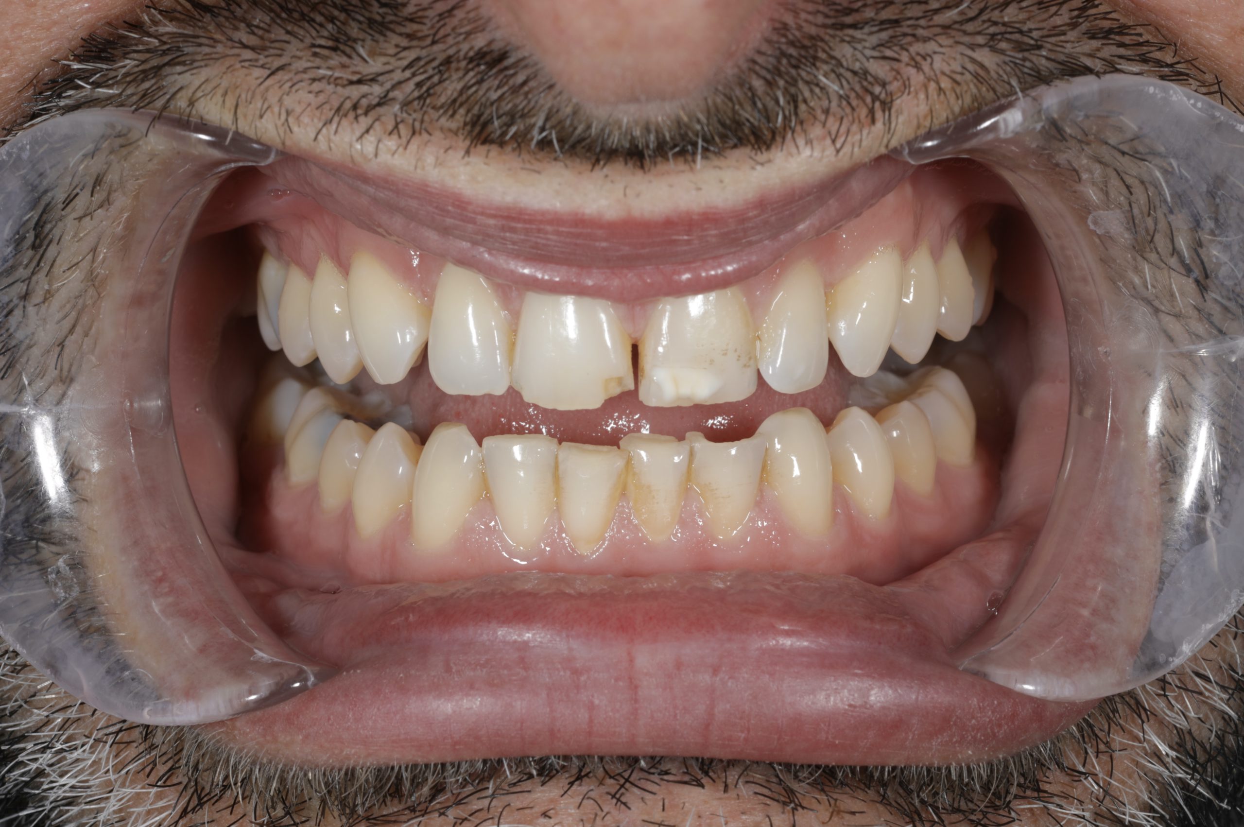 In-Office Teeth Whitening followed by Composite Veneers and Edge Bonding